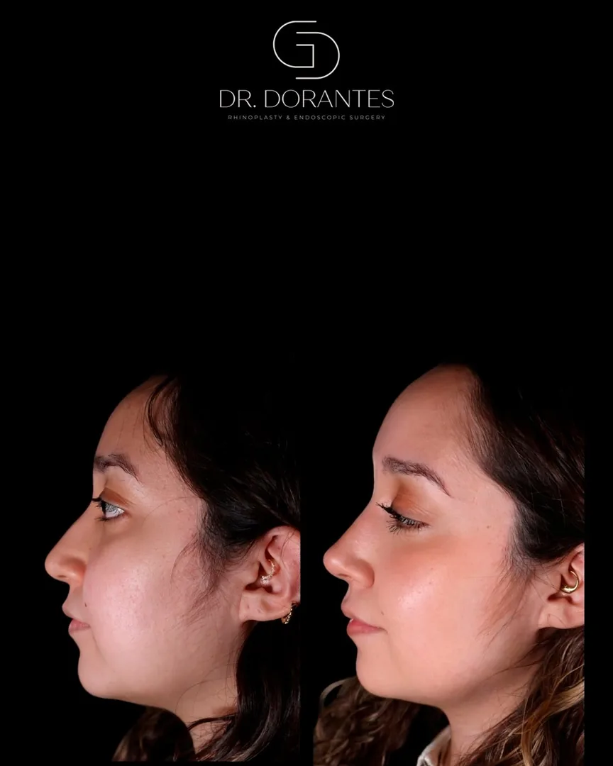 Caso real — Rinoplastia