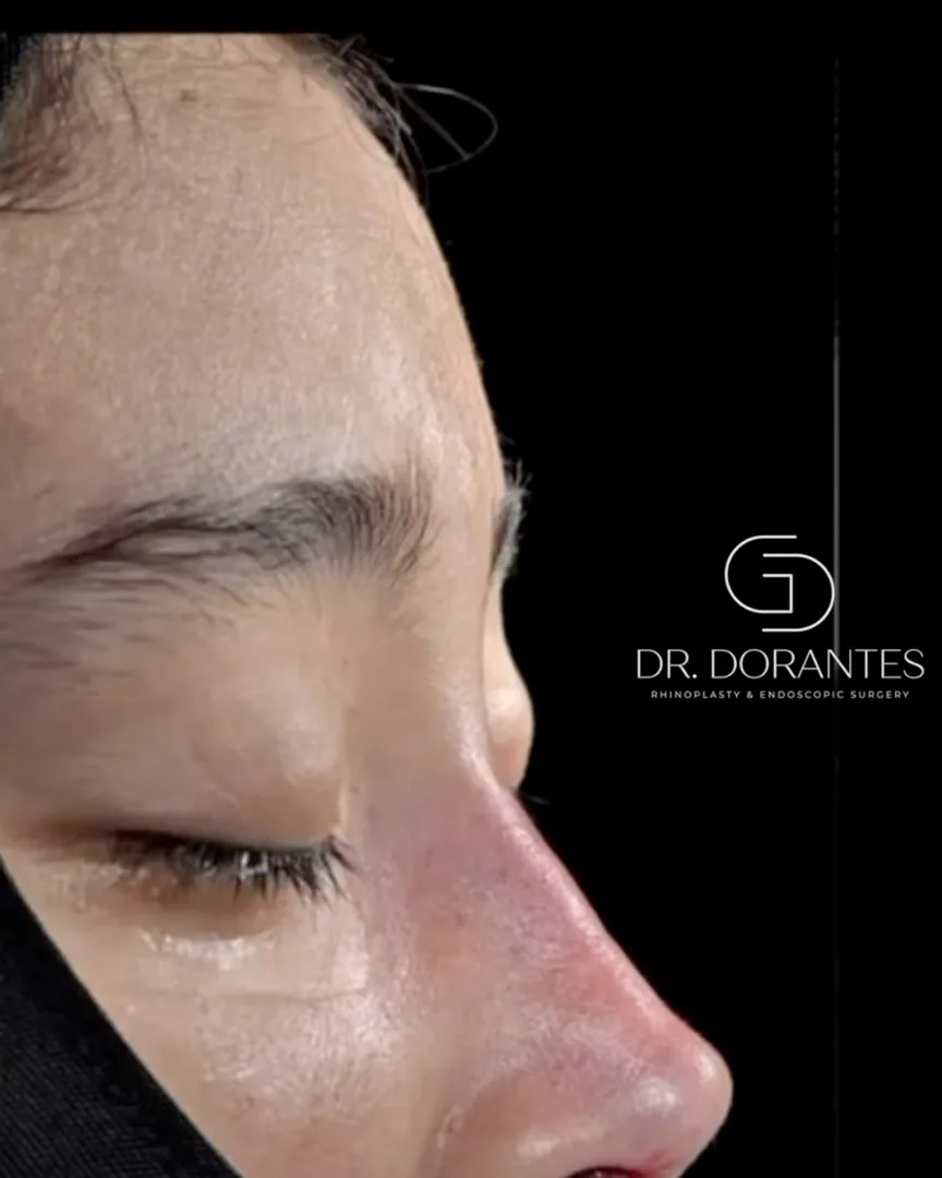 Reel — Rinoplastia