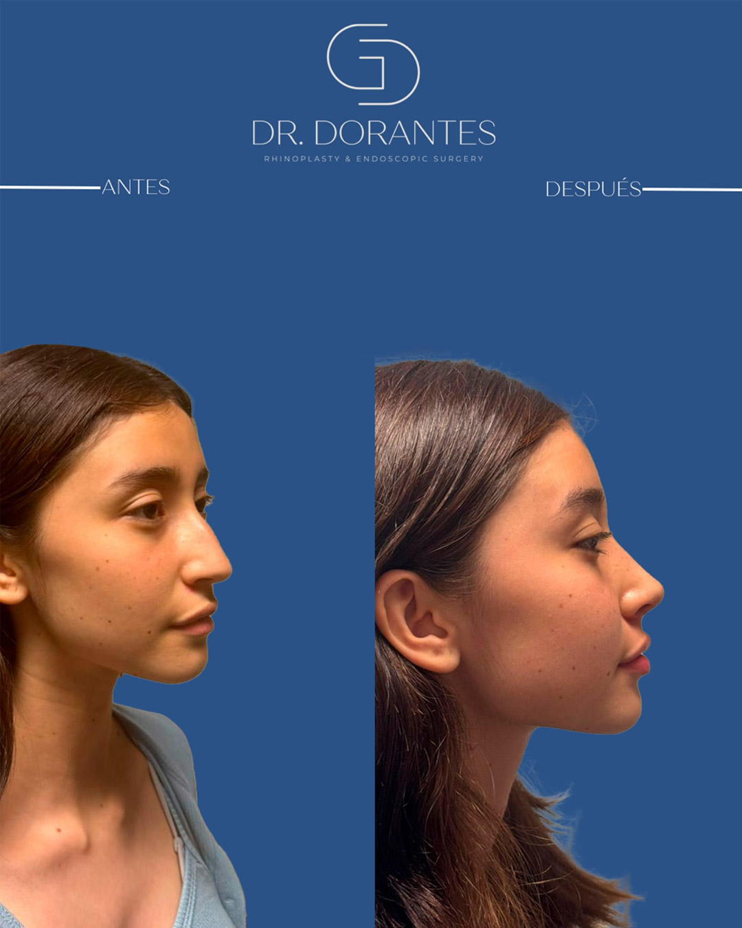 Caso real — Rinoplastia