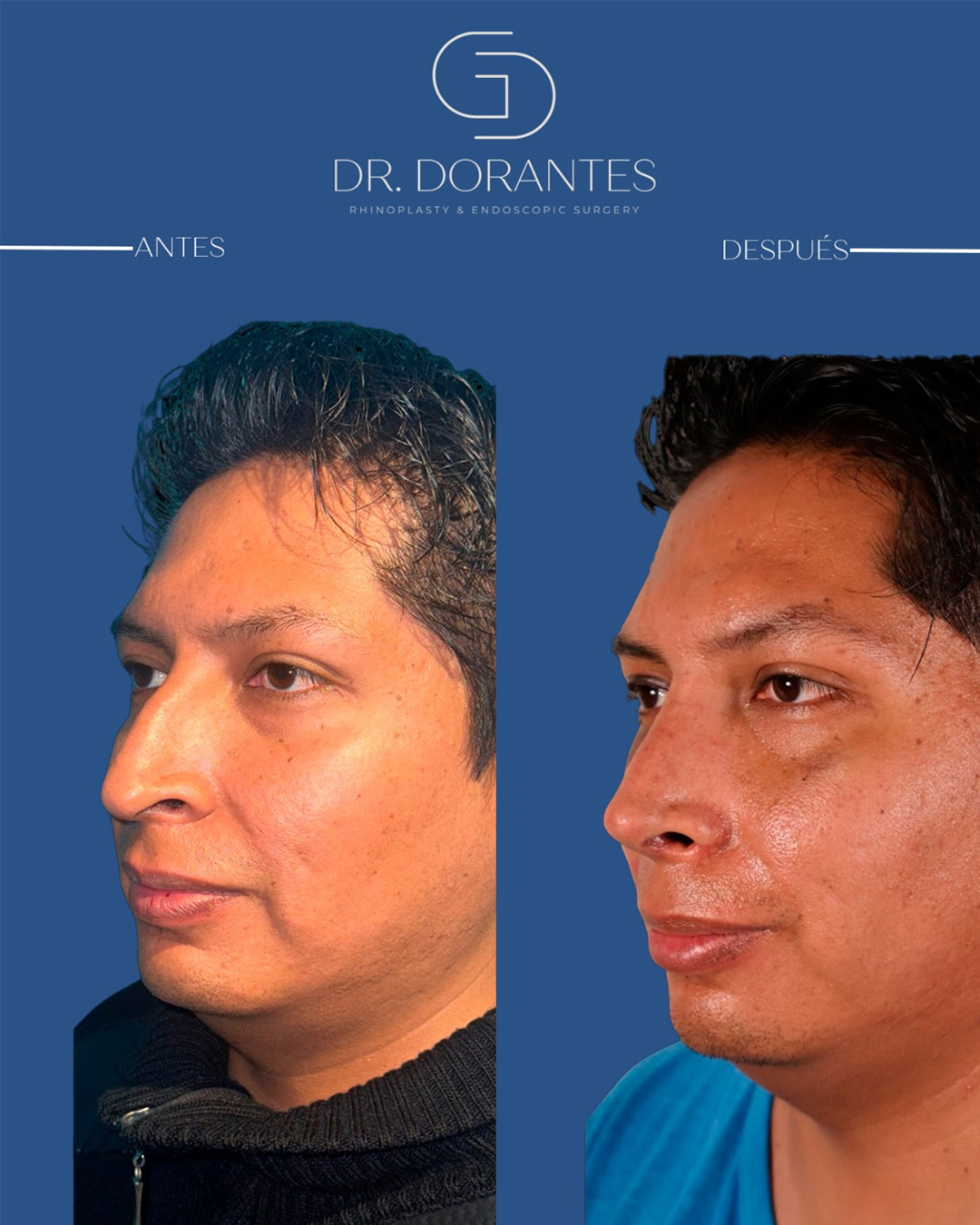Caso real — Rinoplastia