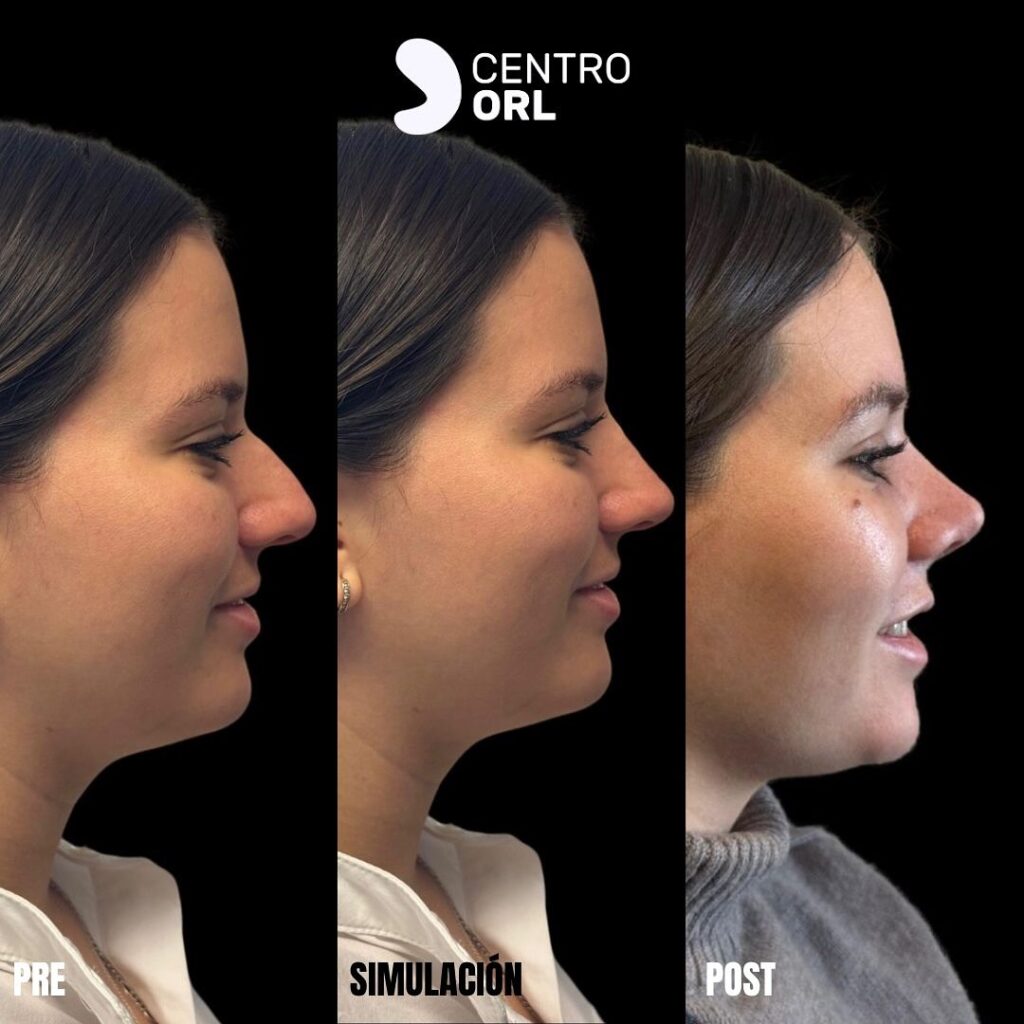 Rinoplastia funcional y estética